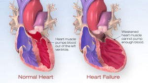 Heart failure is the most common type of heart disease. It occurs when the heart doesn't pump blood as well as it should. (Courtesy American Heart Association) 