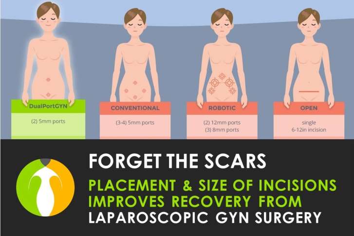Cosmetically Placed Laparoscopic Incisions Help Women Recover From Gyn
