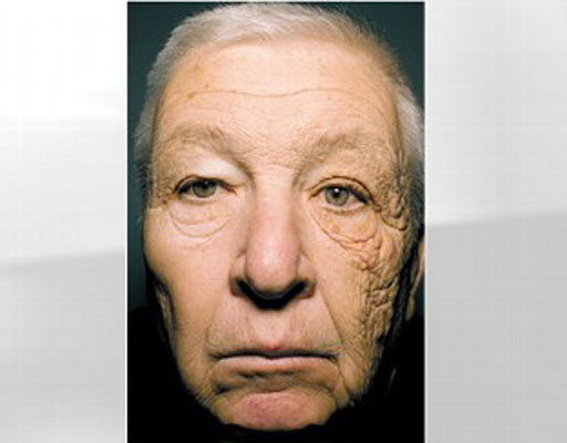 Man’s face is aged 20 years only on one side