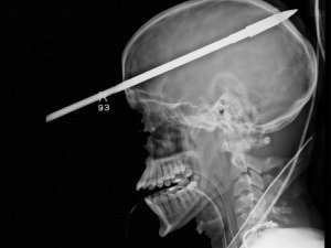 Teen recovering after he’s shot in head with spear