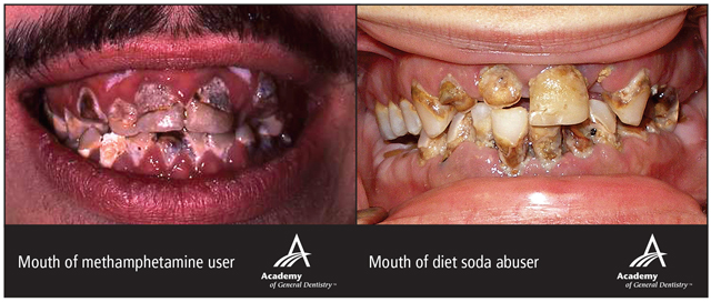 Diet soda corrodes teeth as badly as illicit drugs, study finds