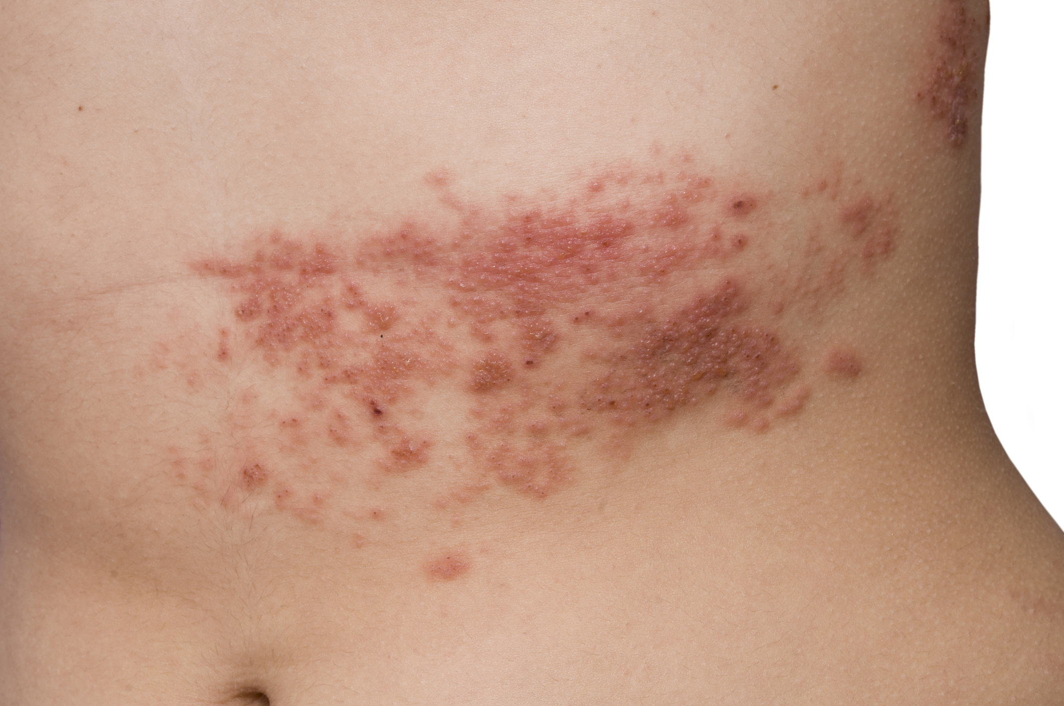 Study: Shingles in young adults can increase risk for heart attack
