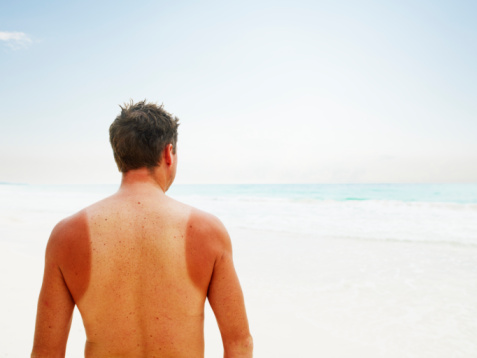 Video explains what actually causes sunburn