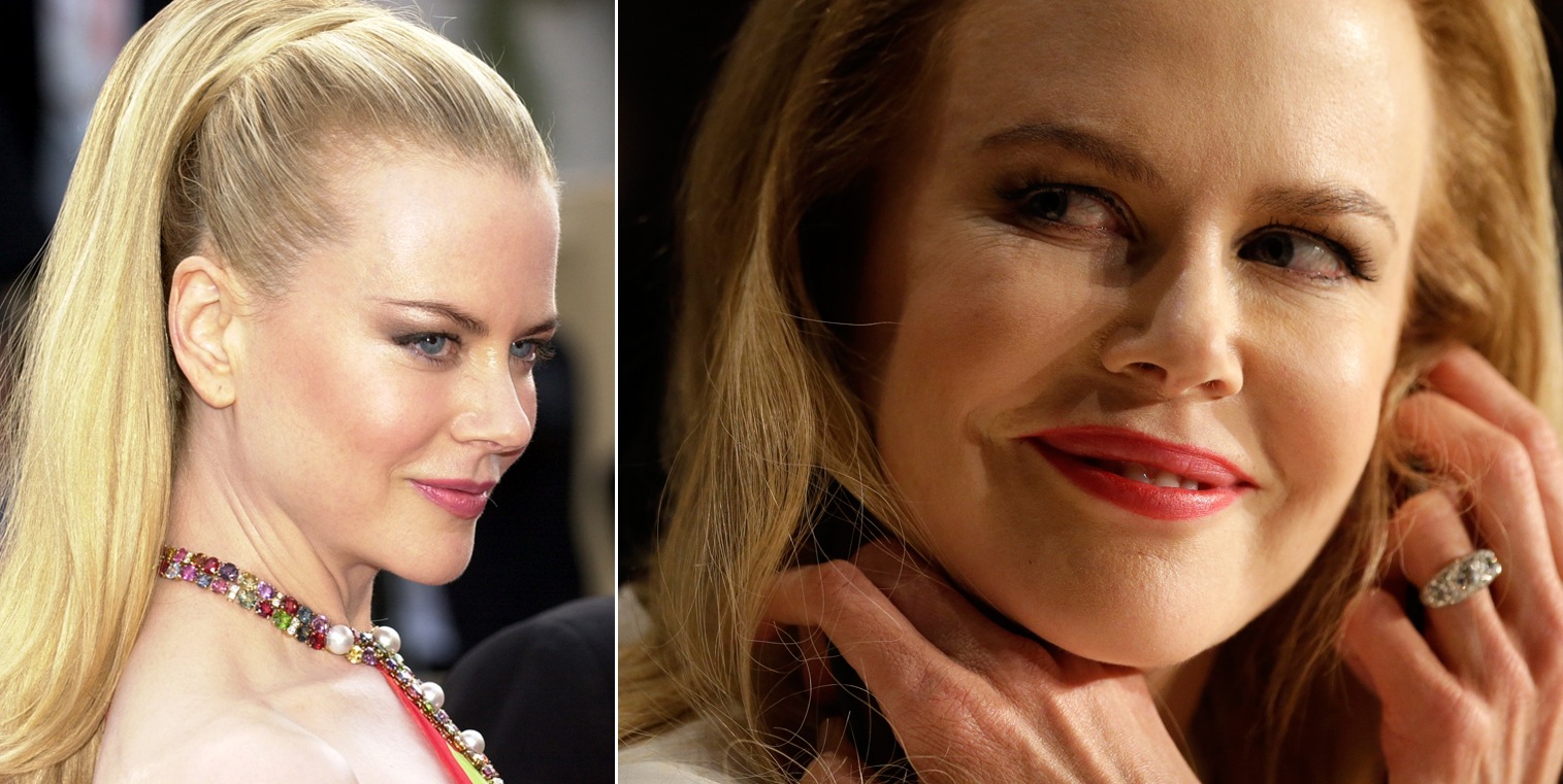 Nicole Kidman’s face sparks conversation about Botox