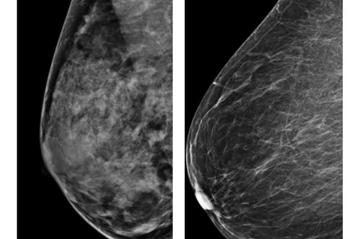 Study shows many women don't know dangers of dense breast tissue | WTOP