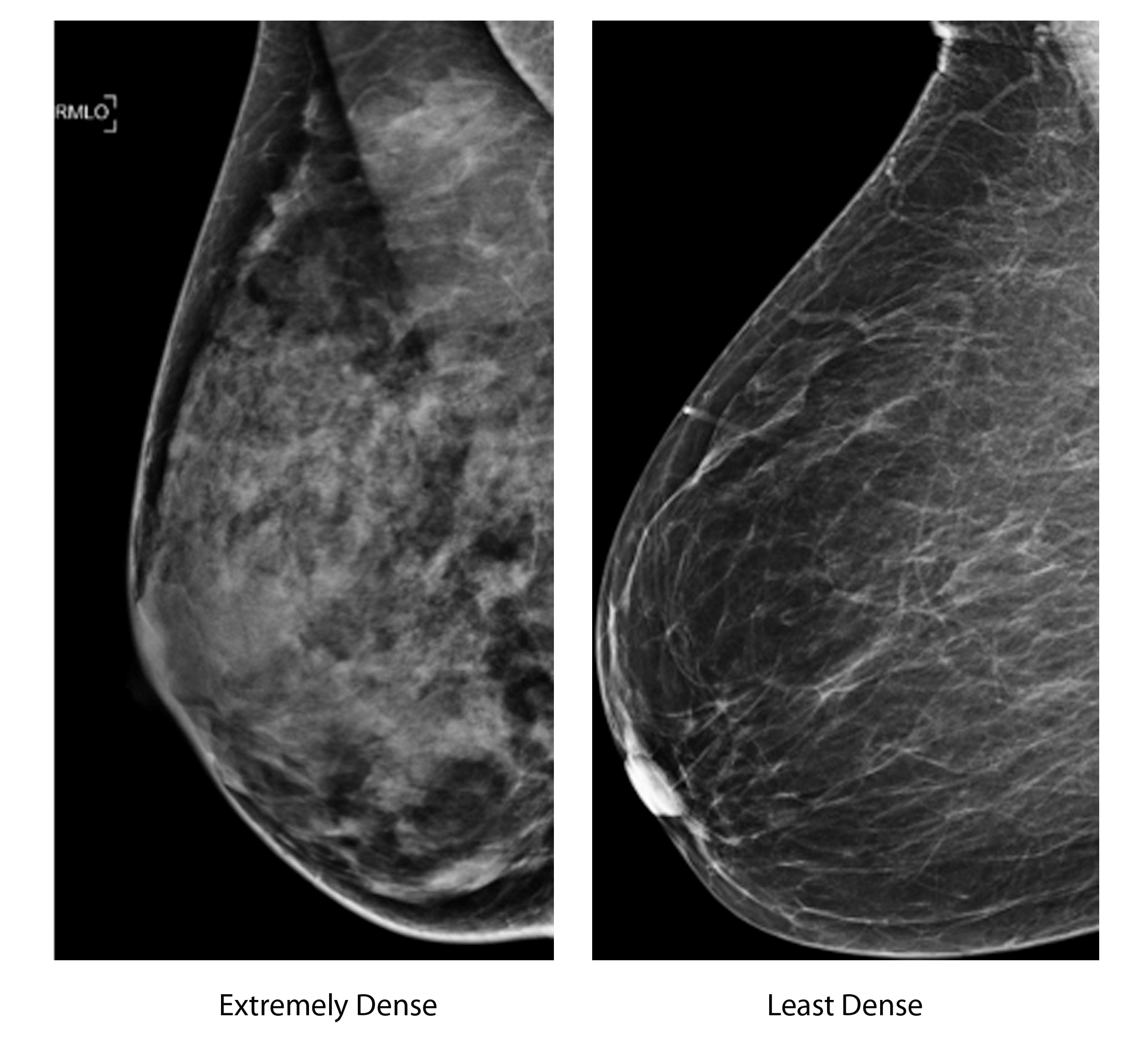Study shows many women don’t know dangers of dense breast tissue