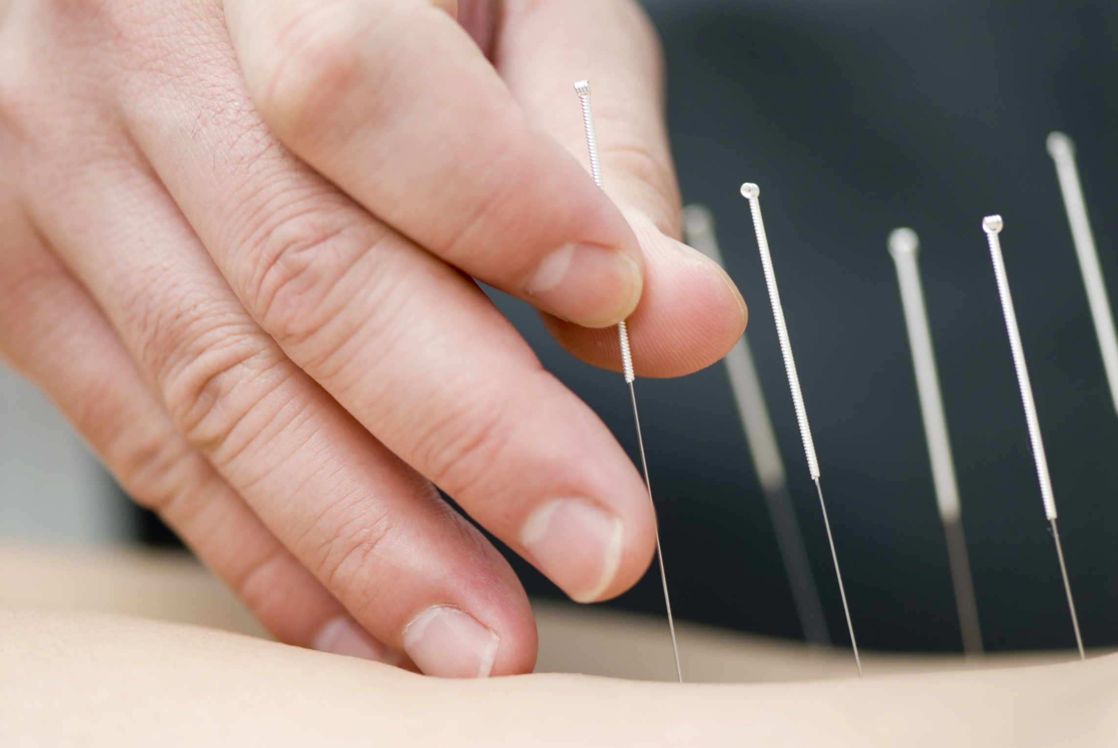 Can acupuncture help you lose weight?