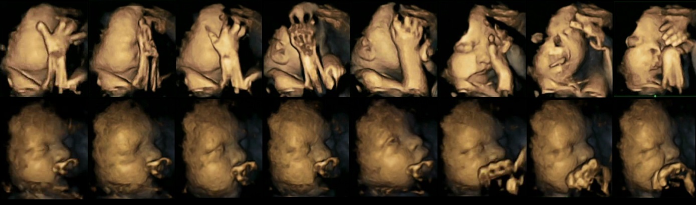 Smoking during pregnancy could alter babies’ facial movement in the womb