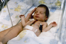 Baby Fae who is the receipient of a transplanted baboon heart. Baby Fae is seen at Loma Linda University Medical Center, November 1984. (AP Photo/Duane R. Miller)