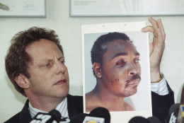 **WARNING: Graphic Content** Steven Lerman, attorney for Rodney King, displays a photo of his client during a press conference at his office in Beverly Hills, California, Friday, March 8, 1991. King's doctor outlined the extent of man's injuries for reporters during the meeting. (AP Photo/Nick Ut)