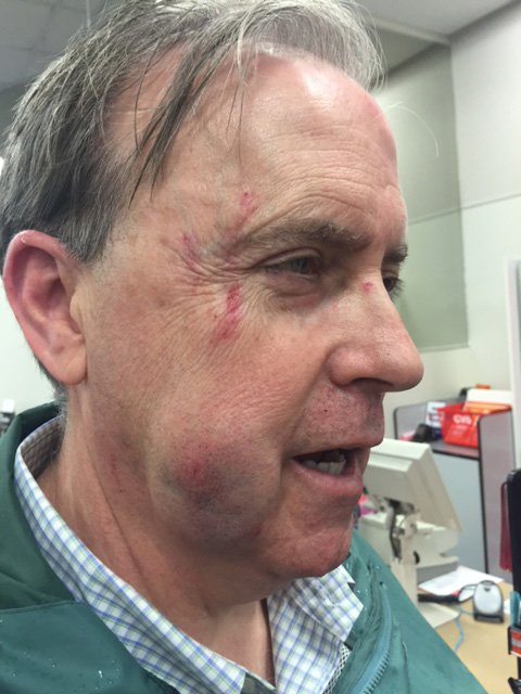 An attack Friday evening at Metro's Gallery Place platform left John Rowley, 62, with severe facial bruises and a broken hand. (Courtesy John Rowley)