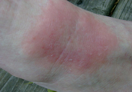 A bull's eye rash is one of the symptoms indicating Lyme disease. (Courtesy Mike Raupp/University of Maryland)