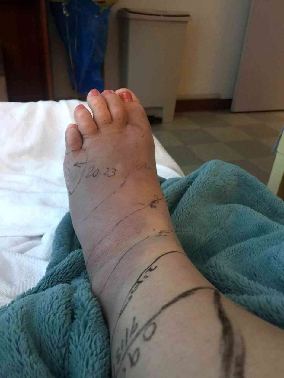 The snake bite and treatment have severely limited her mobility, and she says she is still in considerable pain. (Courtesy Rachel Myrick) 