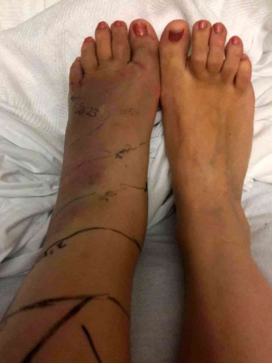 Picture shows Rachel Myrick's affected foot and how swollen it is compared to her unaffected foot. (Courtesy Rachel Myrick) 