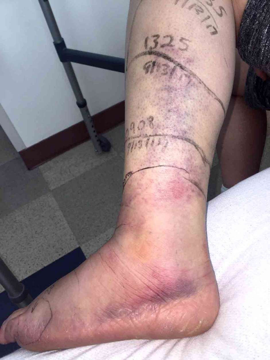 Rachel Myrick was given anti-venom for the swelling of her foot. (Courtesy Rachel Myrick) 