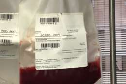 A few hours later, a pouch was filled with Glicks stem cells. (Courtesy Jenny Glick)