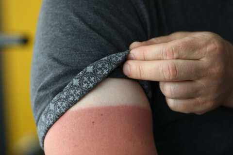 How to treat sunburn fast