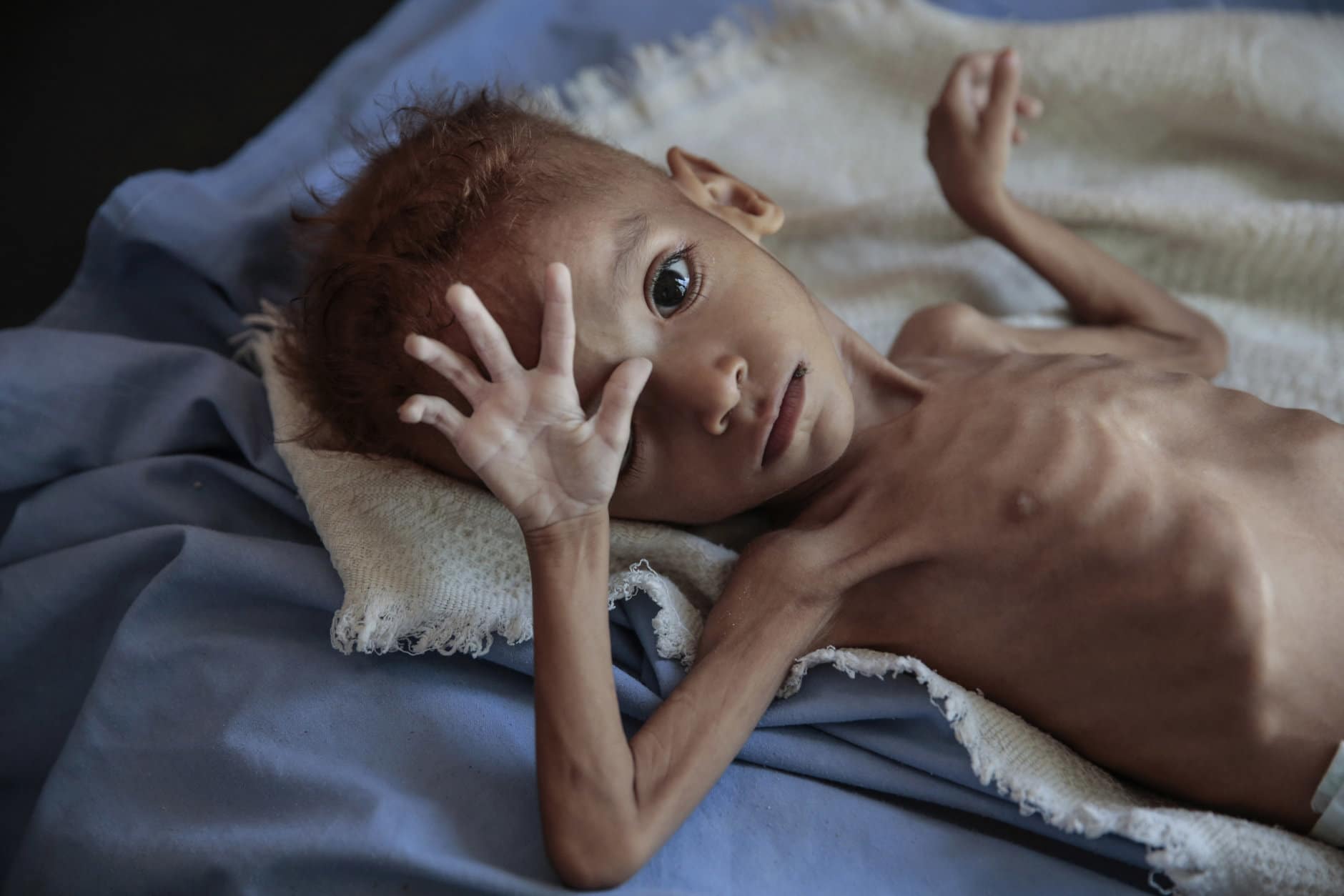 A severely malnourished boy rests on a hospital bed at the Aslam Health Center, in Hajjah, Yemen, on Oct. 1, 2018. Malnutrition, cholera, and other epidemic diseases have ravaged through displaced and impoverished communities in Yemen, threatening to worsen the world's largest humanitarian crisis. (AP Photo/Hani Mohammed)