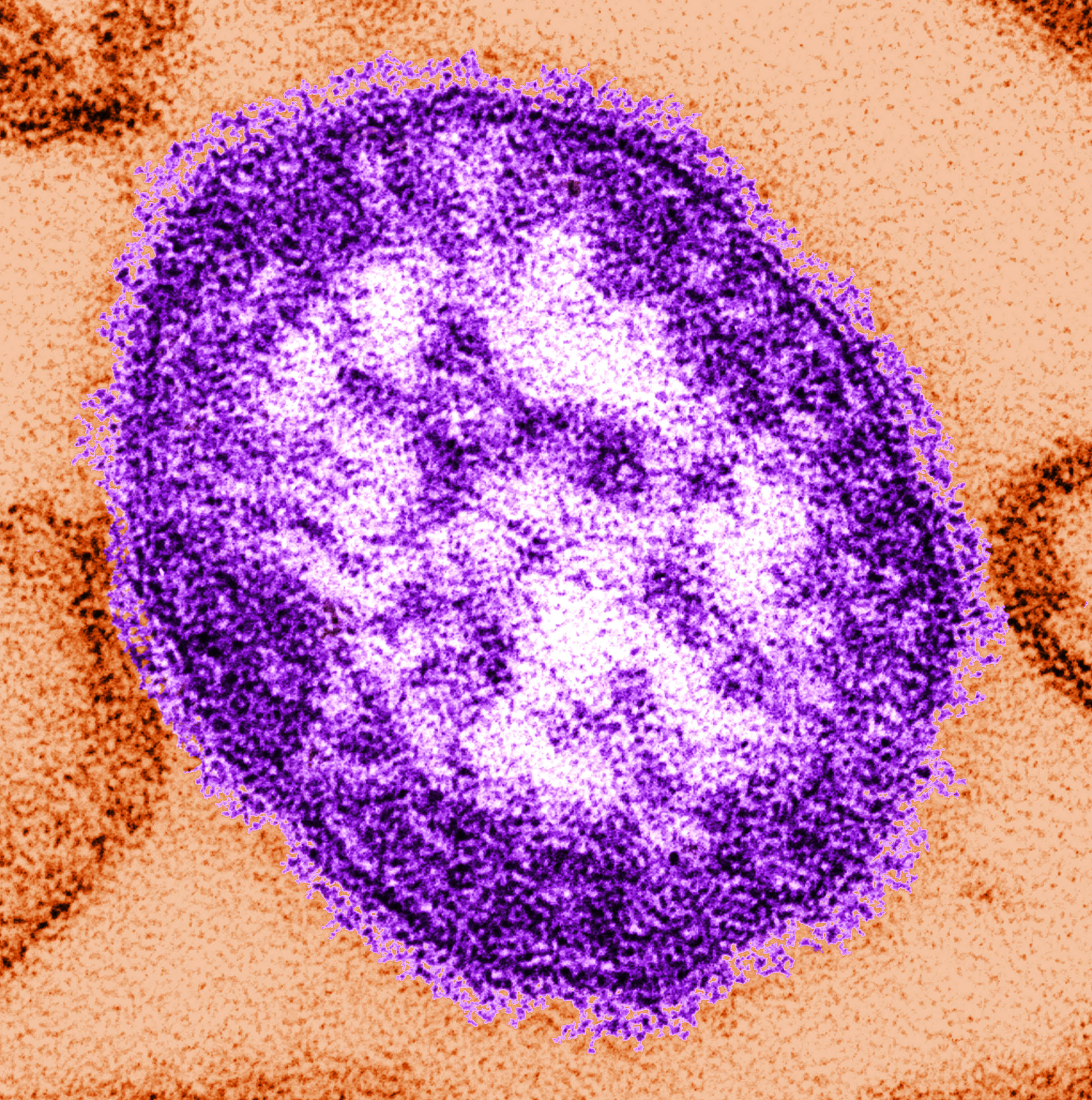 Virginia investigates possible measles exposure at Dulles, Inova - WTOP thumbnail
