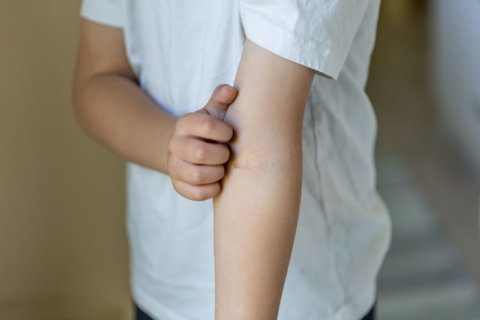 Eczema in kids: What parents can do to calm the itch