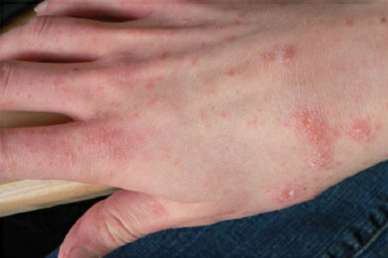 28 Confirmed Cases Of Scabies Among Prince George S Co