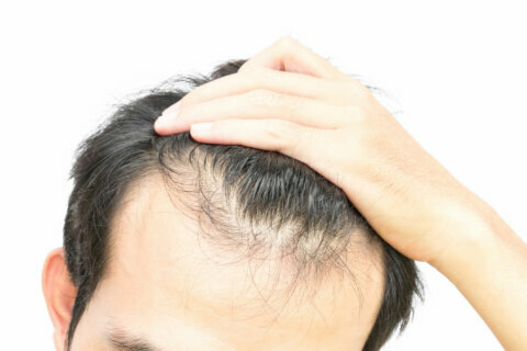 The pill that could be an option to treat pattern baldness