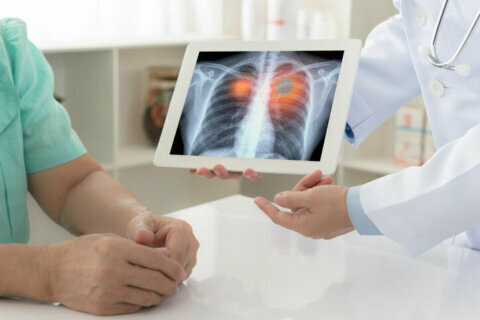 Lung cancer: When to get screened