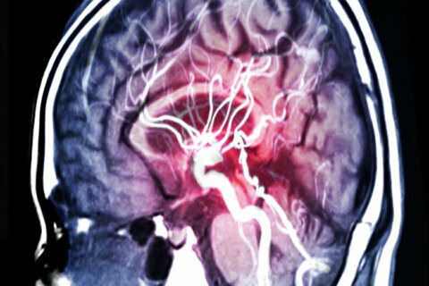 What to do if your family history includes brain aneurysm