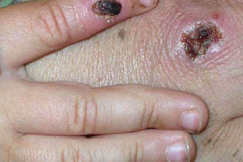Case of monkeypox confirmed in Maryland 
