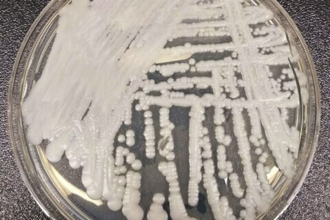 ‘Superbug’ fungus spread in two cities, health officials say