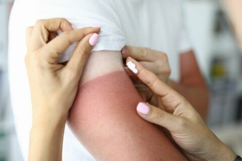 Dos and don’ts of at-home sunburn treatment