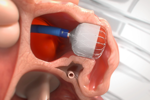 Implantable heart plug reduces threat of stroke in people with irregular heartbeats