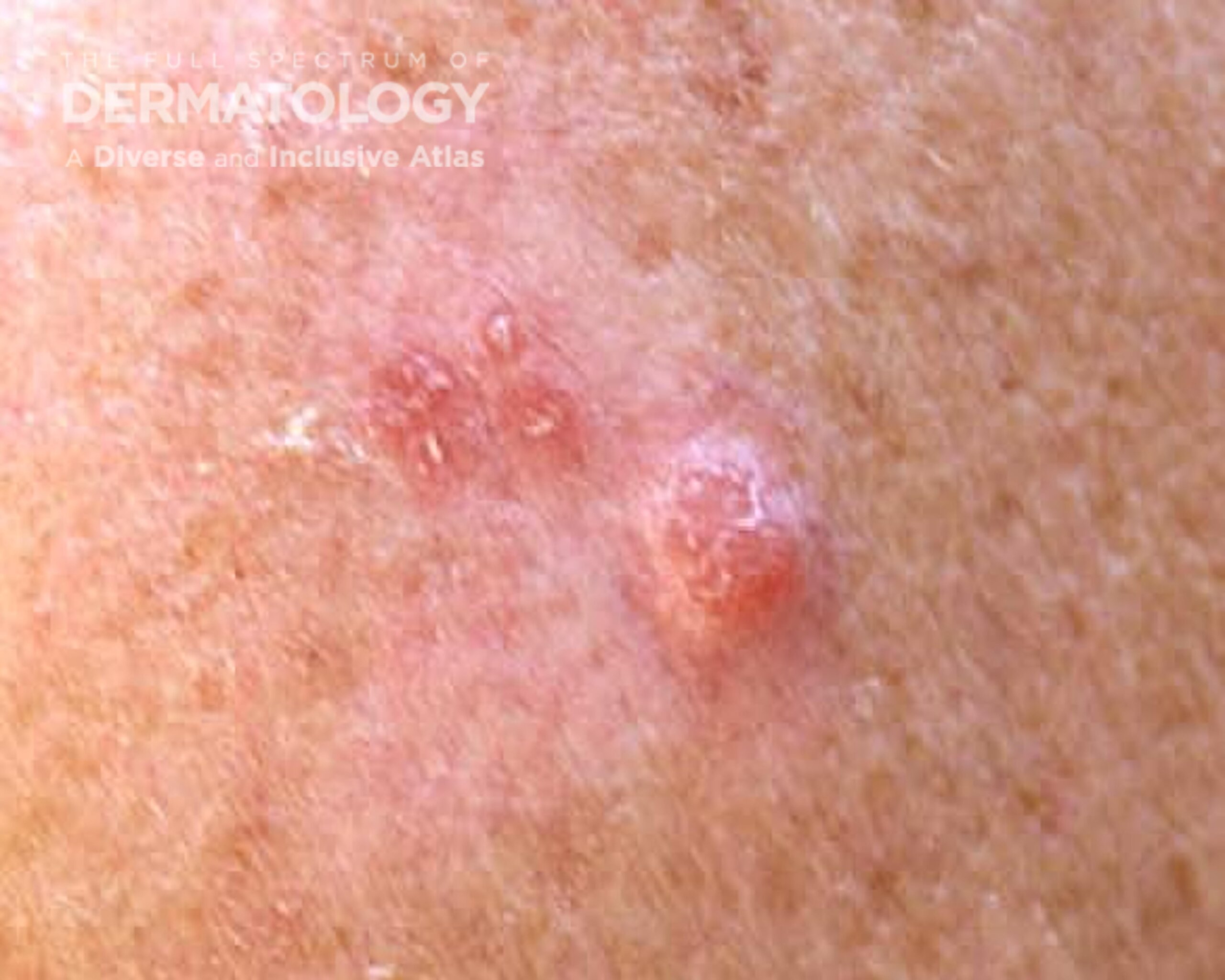 Deadly skin cancer can appear anywhere on the body, even where the sun doesn’t shine