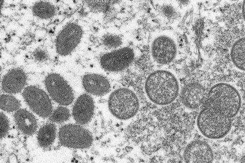 Virginia reports 1st presumed case of monkeypox