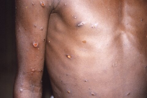 Monkeypox outbreak needs a united response, says WHO Africa
