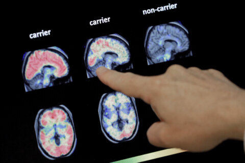 After promising data, experts say many questions remain over an experimental Alzheimer’s drug