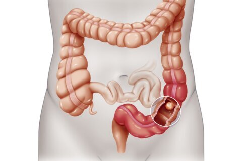 A colonoscopy study has some wondering if they should have the procedure. What you should know