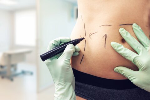 Liposuction overtakes breast augmentation as most popular cosmetic surgery