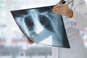 New treatments spur hope after lung cancer diagnosis but screening still lags