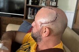 man with scar on his head