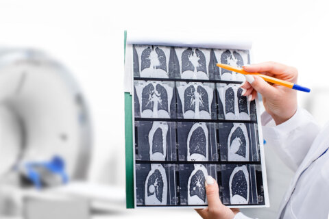 George Washington Univ. Hospital helping DC residents get access to lung cancer screenings