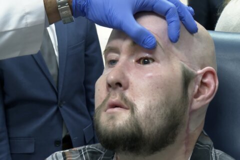 Man receives the first eye transplant plus a new face. It’s a step toward one day restoring sight