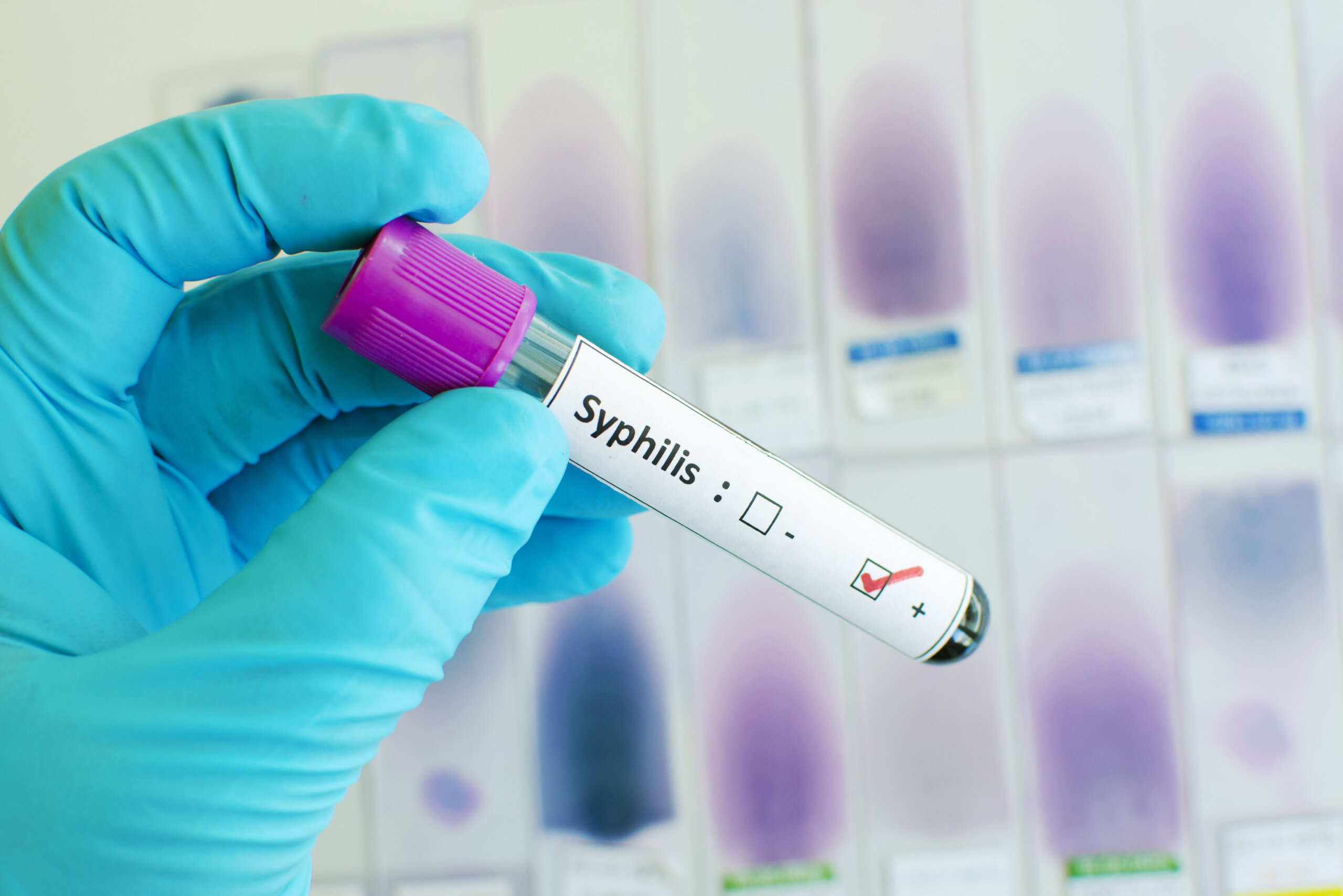 Virginia health department launches new webpage to track syphilis cases – WTOP News