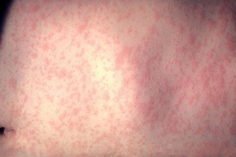 Single case of measles confirmed in DC area
