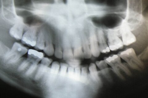 Getting a dental X-ray? A new recommendation says you don’t need a lead apron