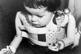 A three-year-old girl, born without arms to a German mother who took the drug thalidomide, uses power-driven artificial arms fitted to her by Dr. Ernst Marquardt of the University of Heidelberg in Germany, 1965.  The child activates the artificial arms by moving her shoulders.  (AP Photo)