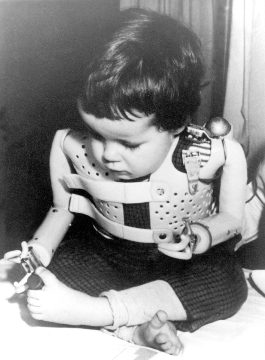 A three-year-old girl, born without arms to a German mother who took the drug thalidomide, uses power-driven artificial arms fitted to her by Dr. Ernst Marquardt of the University of Heidelberg in Germany, 1965.  The child activates the artificial arms by moving her shoulders.  (AP Photo)