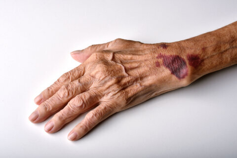 What causes you to bruise more as you age and how to prevent it