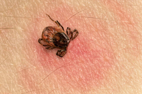 How to protect children from Lyme disease during peak tick season