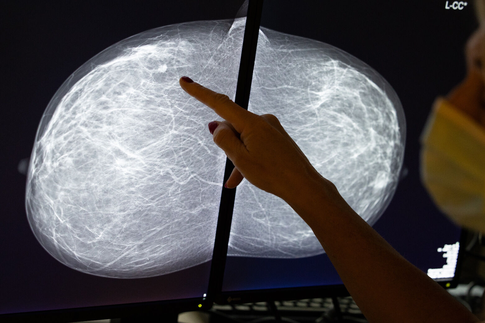 Dense or not dense: Md. physician says updates to mammogram readings now required by FDA help empower women